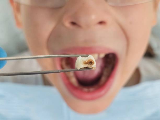 Best Emergency Dental Care for Broken or Chipped Teeth in Rutland, VT